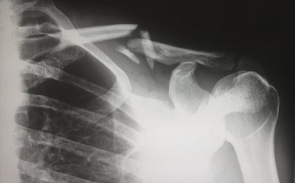 Separovic Injury Lawyers X-ray of Broken Shoulder